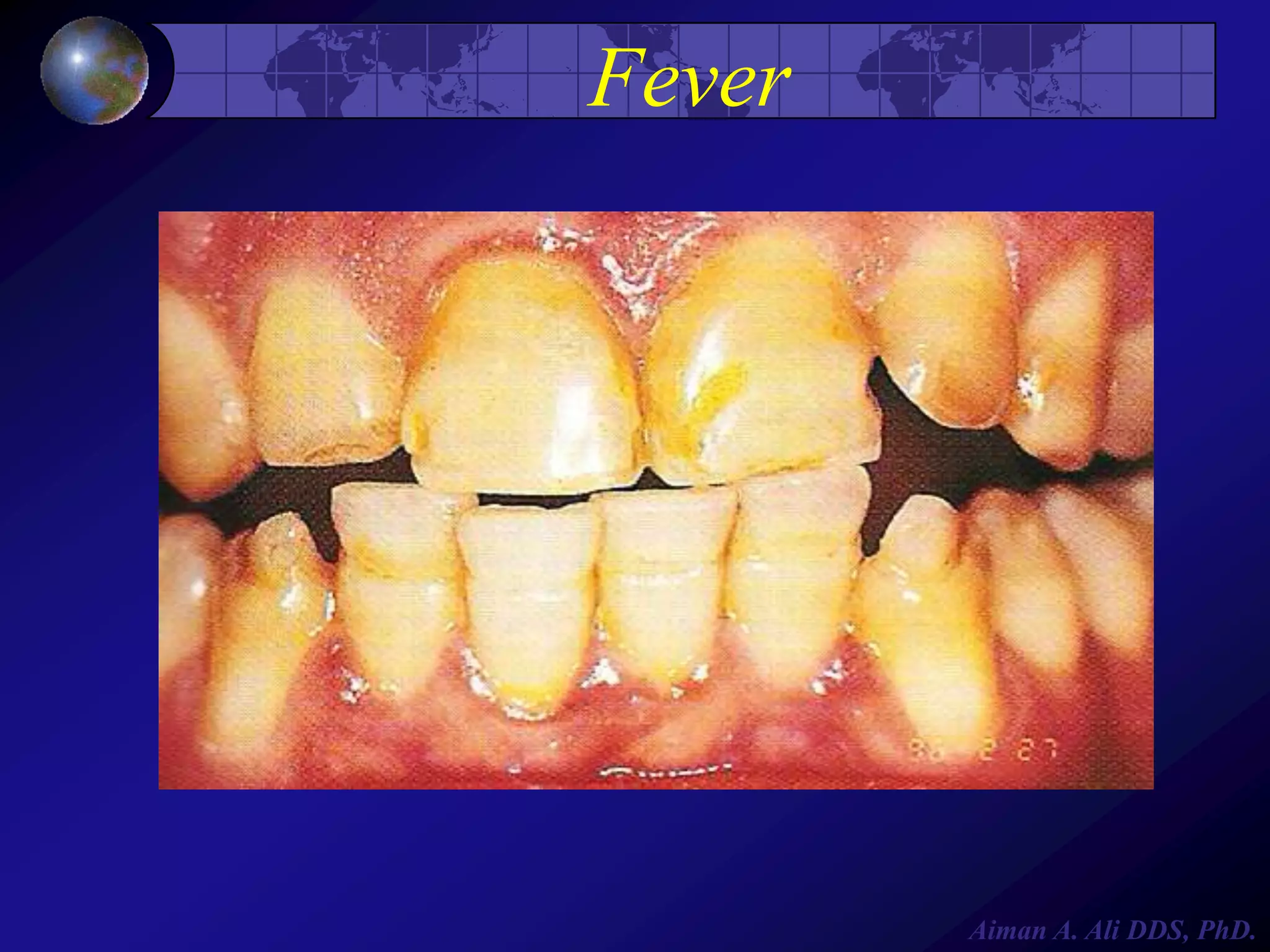 Fever

Aiman A. Ali DDS, PhD.

 