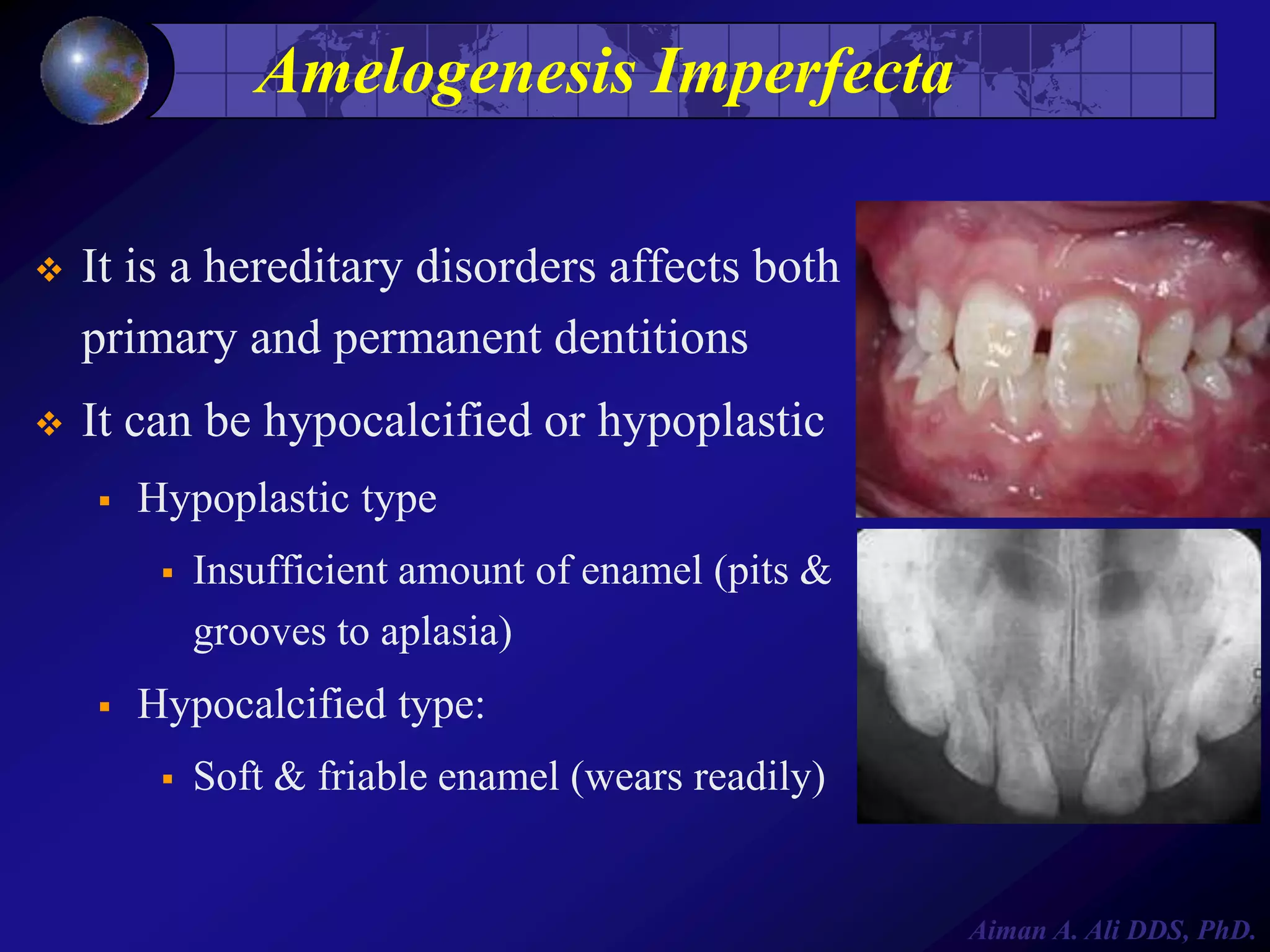 Amelogenesis Imperfecta


It is a hereditary disorders affects both
primary and permanent dentitions



It can be hypocalcified or hypoplastic


Hypoplastic type




Insufficient amount of enamel (pits &
grooves to aplasia)

Hypocalcified type:


Soft & friable enamel (wears readily)

Aiman A. Ali DDS, PhD.

 