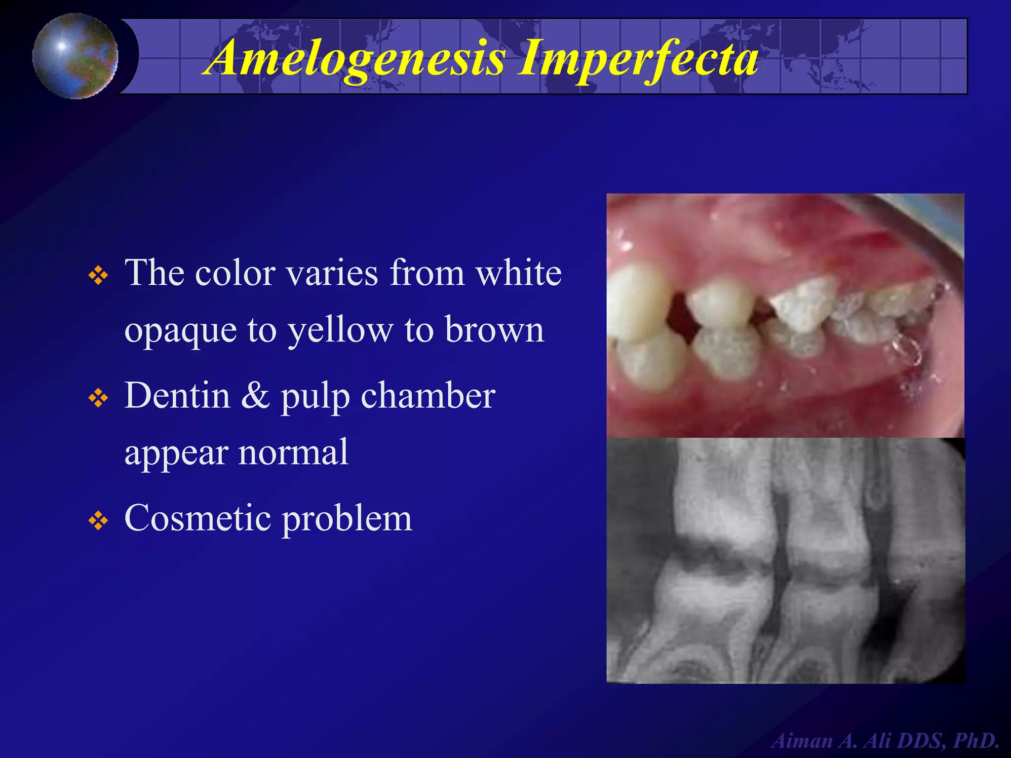 Amelogenesis Imperfecta



The color varies from white
opaque to yellow to brown



Dentin & pulp chamber
appear normal



Cosmetic problem

Aiman A. Ali DDS, PhD.

 