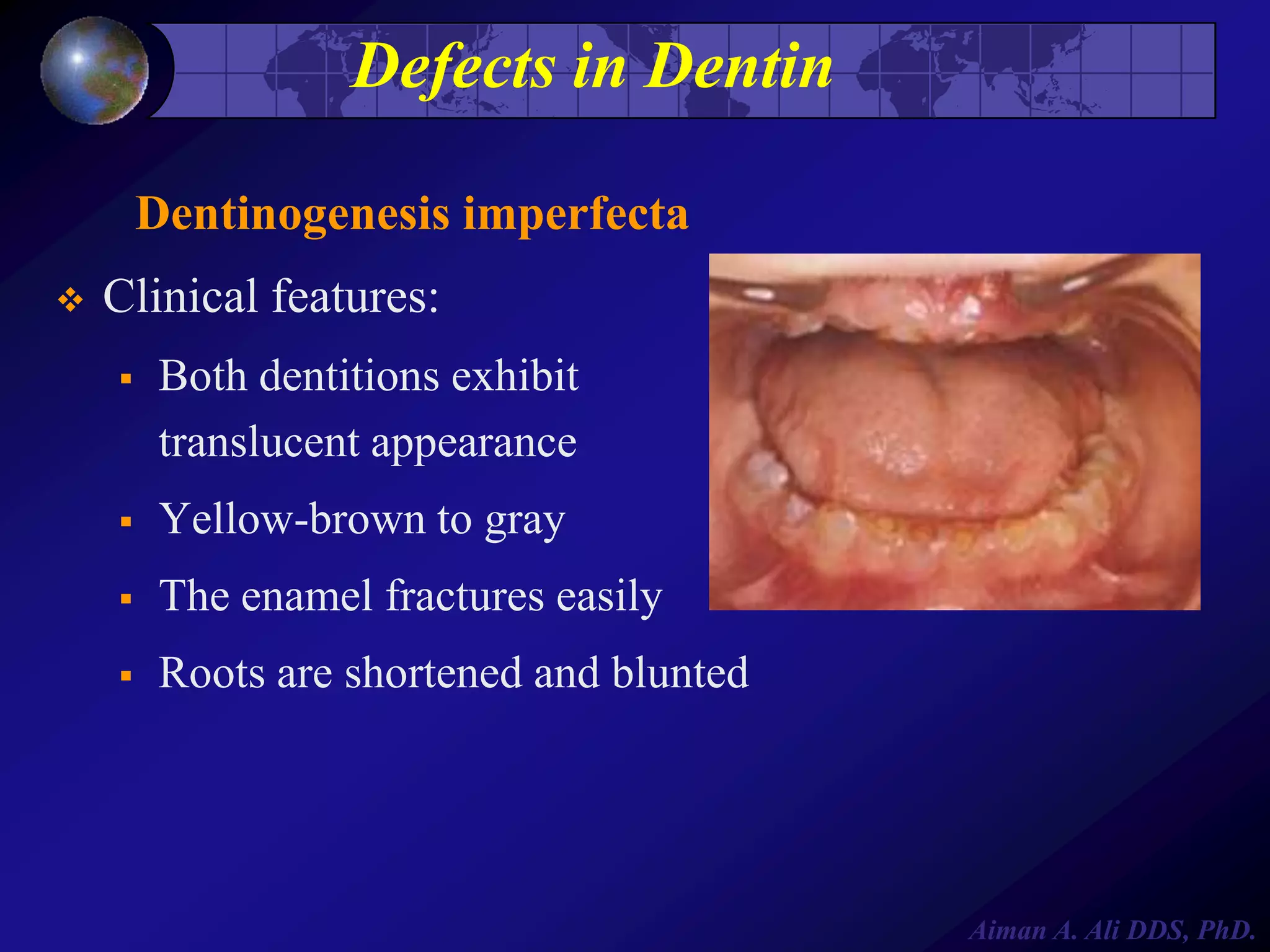 Defects in Dentin
Dentinogenesis imperfecta


Clinical features:


Both dentitions exhibit
translucent appearance



Yellow-brown to gray



The enamel fractures easily



Roots are shortened and blunted

Aiman A. Ali DDS, PhD.

 