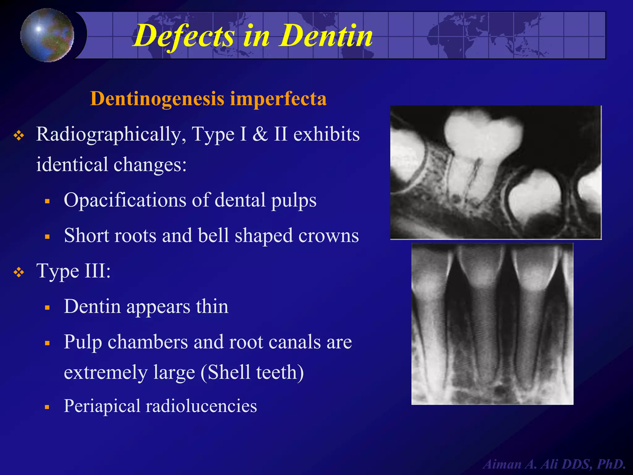 Defects in Dentin
Dentinogenesis imperfecta


Radiographically, Type I & II exhibits
identical changes:





Opacifications of dental pulps
Short roots and bell shaped crowns

Type III:


Dentin appears thin



Pulp chambers and root canals are
extremely large (Shell teeth)



Periapical radiolucencies
Aiman A. Ali DDS, PhD.

 