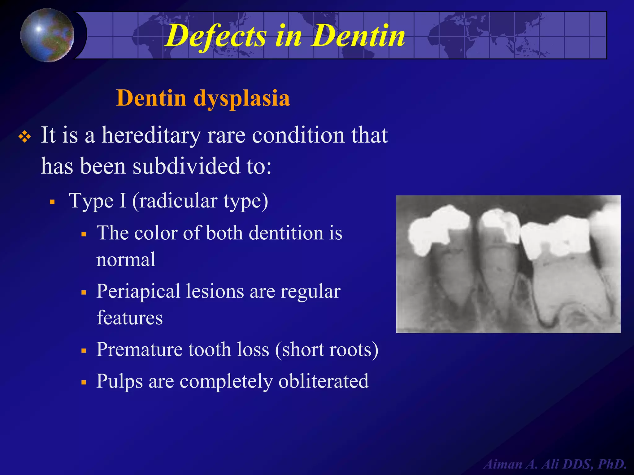 Defects in Dentin
Dentin dysplasia


It is a hereditary rare condition that
has been subdivided to:


Type I (radicular type)
 The color of both dentition is
normal
 Periapical lesions are regular
features
 Premature tooth loss (short roots)
 Pulps are completely obliterated

Aiman A. Ali DDS, PhD.

 