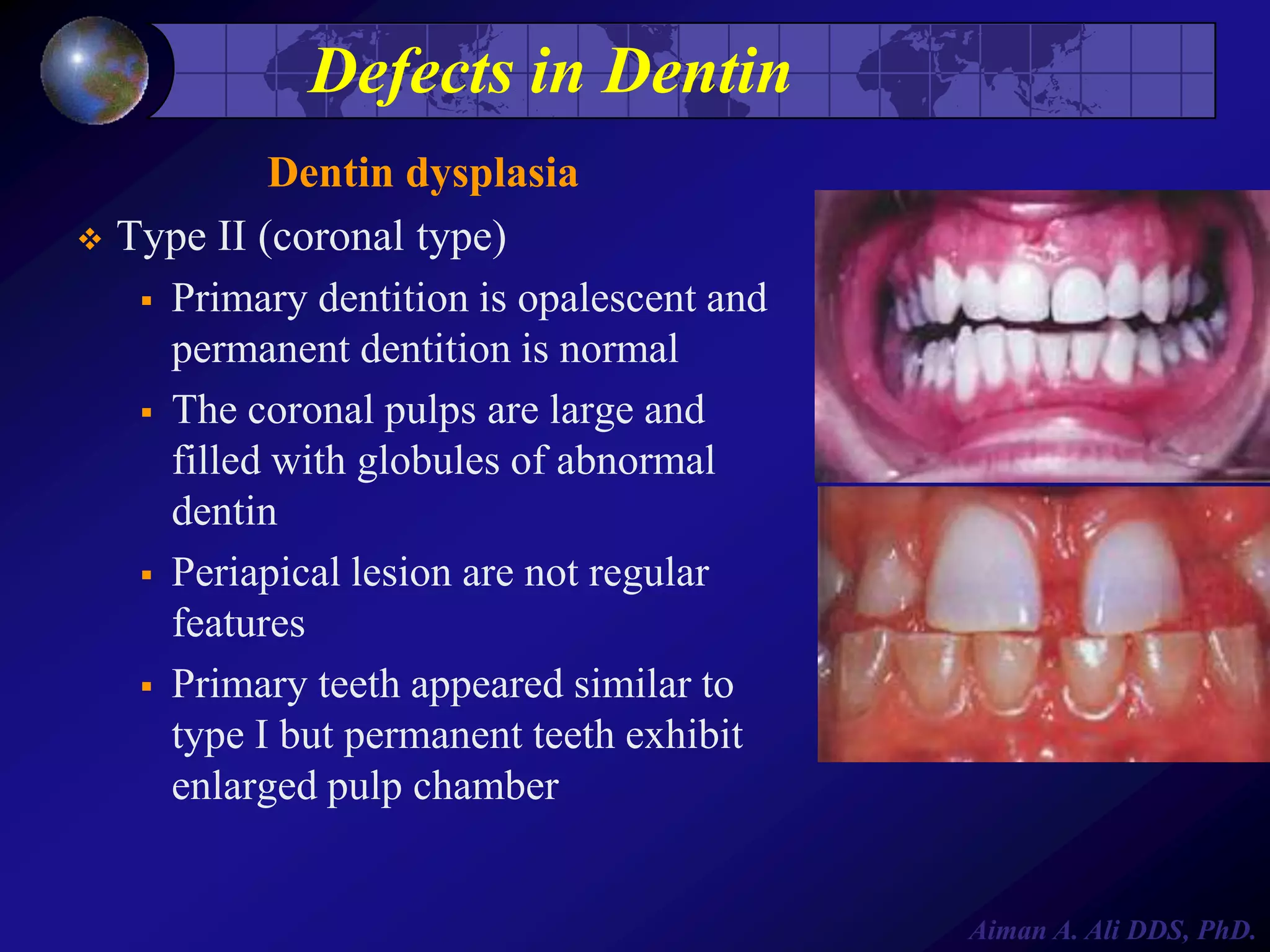 Defects in Dentin
Dentin dysplasia
 Type II (coronal type)
 Primary dentition is opalescent and
permanent dentition is normal
 The coronal pulps are large and
filled with globules of abnormal
dentin
 Periapical lesion are not regular
features
 Primary teeth appeared similar to
type I but permanent teeth exhibit
enlarged pulp chamber

Aiman A. Ali DDS, PhD.

 