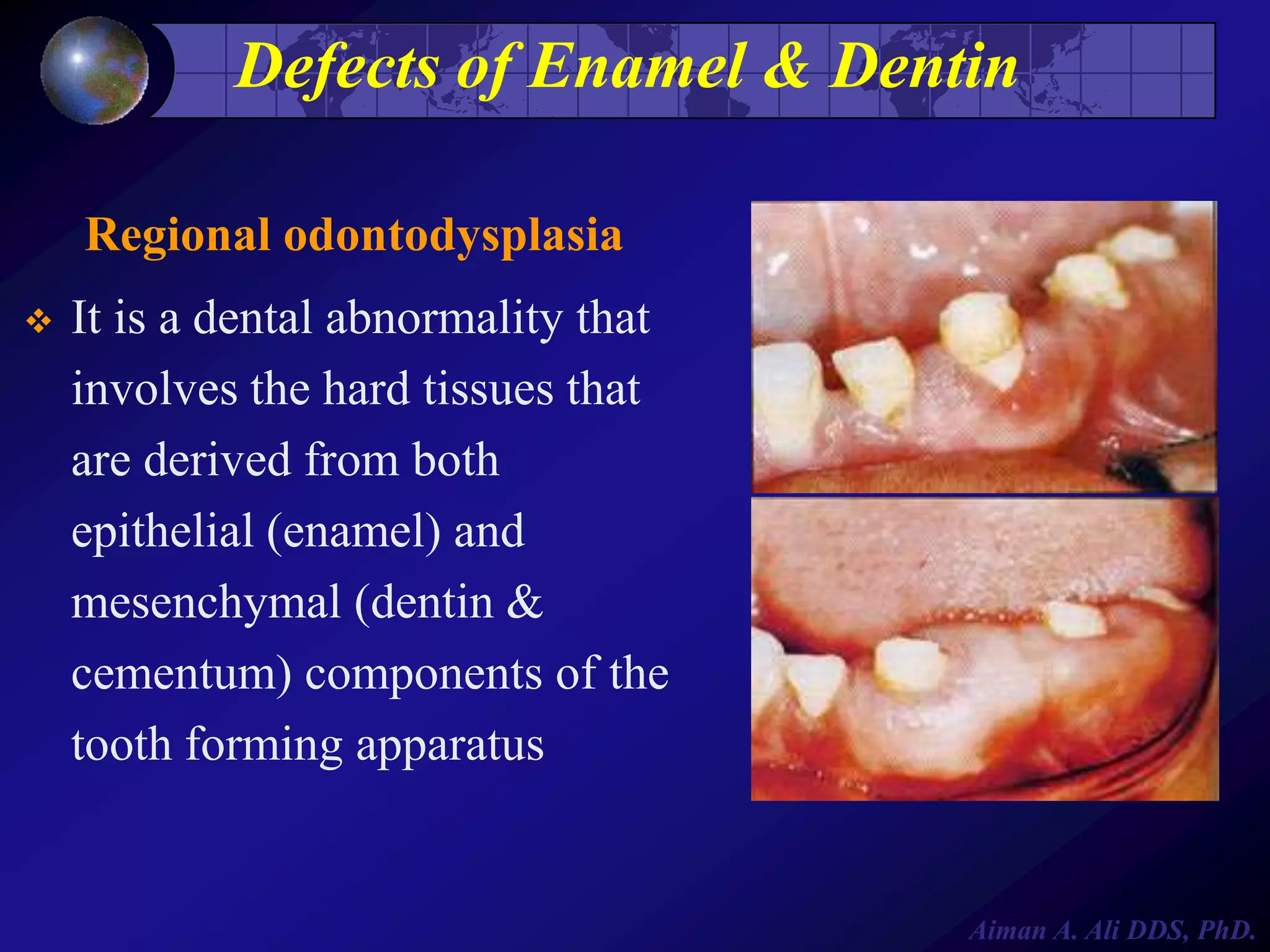 Defects of Enamel & Dentin
Regional odontodysplasia


It is a dental abnormality that
involves the hard tissues that
are derived from both
epithelial (enamel) and
mesenchymal (dentin &
cementum) components of the
tooth forming apparatus

Aiman A. Ali DDS, PhD.

 