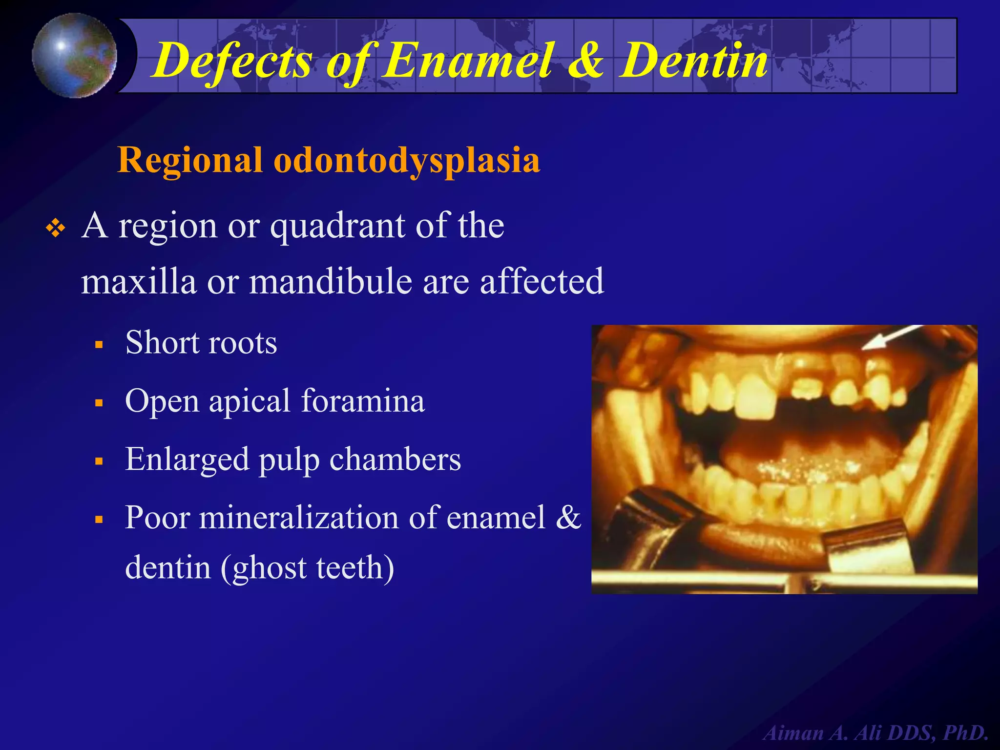 Defects of Enamel & Dentin
Regional odontodysplasia


A region or quadrant of the
maxilla or mandibule are affected


Short roots



Open apical foramina



Enlarged pulp chambers



Poor mineralization of enamel &
dentin (ghost teeth)

Aiman A. Ali DDS, PhD.

 