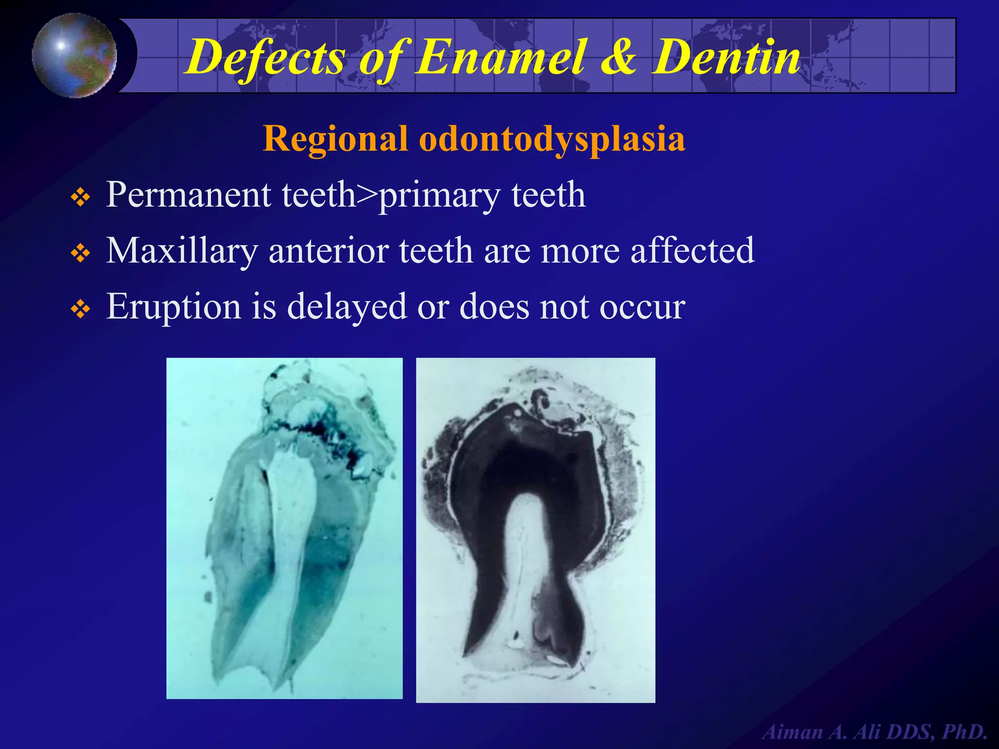 Defects of Enamel & Dentin




Regional odontodysplasia
Permanent teeth>primary teeth
Maxillary anterior teeth are more affected
Eruption is delayed or does not occur

Aiman A. Ali DDS, PhD.

 
