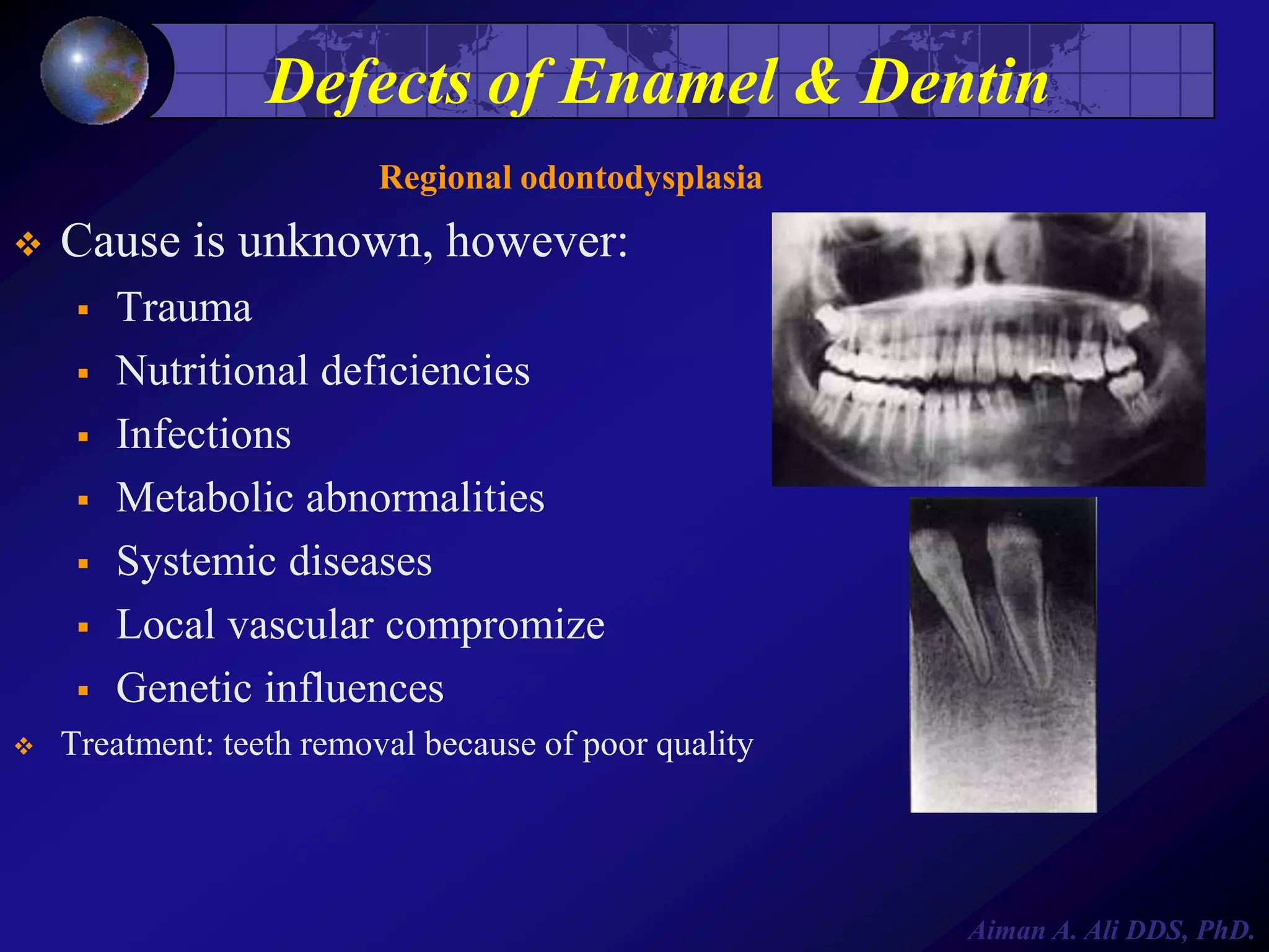 Defects of Enamel & Dentin
Regional odontodysplasia


Cause is unknown, however:










Trauma
Nutritional deficiencies
Infections
Metabolic abnormalities
Systemic diseases
Local vascular compromize
Genetic influences

Treatment: teeth removal because of poor quality

Aiman A. Ali DDS, PhD.

 