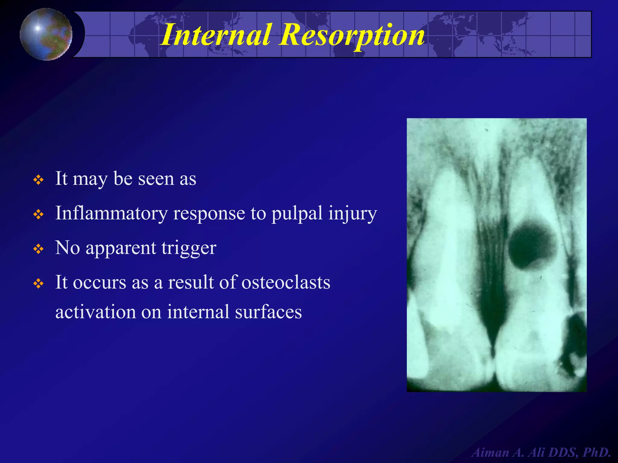 Internal Resorption



It may be seen as



Inflammatory response to pulpal injury



No apparent trigger



It occurs as a result of osteoclasts
activation on internal surfaces

Aiman A. Ali DDS, PhD.

 