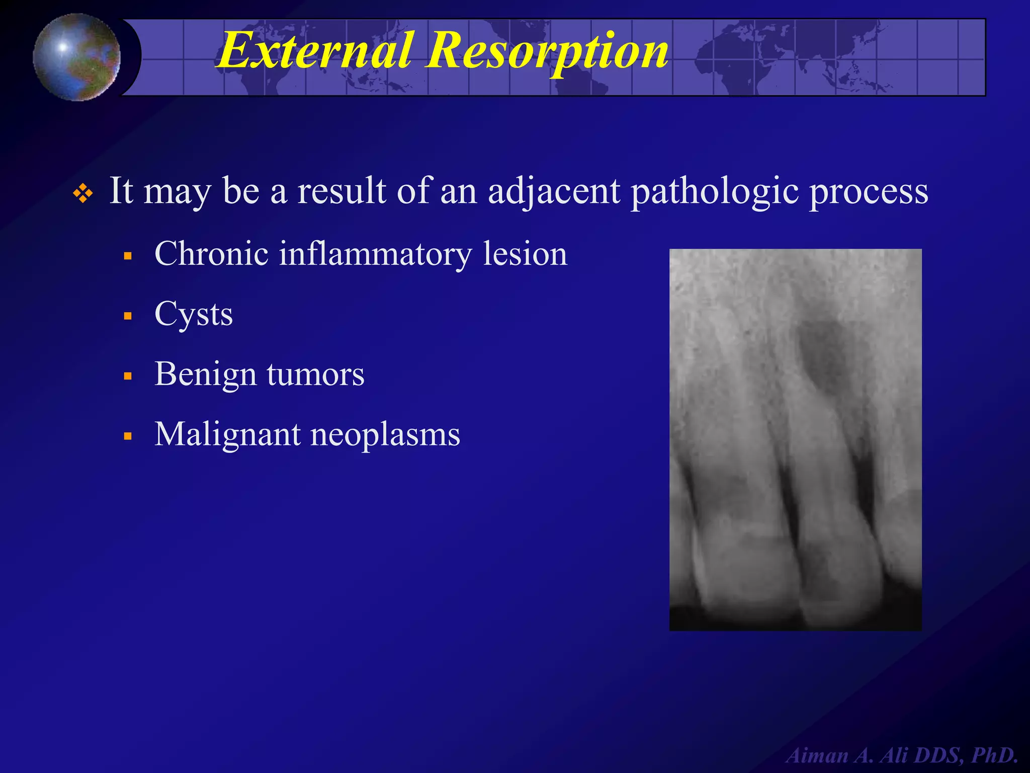 External Resorption


It may be a result of an adjacent pathologic process


Chronic inflammatory lesion



Cysts



Benign tumors



Malignant neoplasms

Aiman A. Ali DDS, PhD.

 