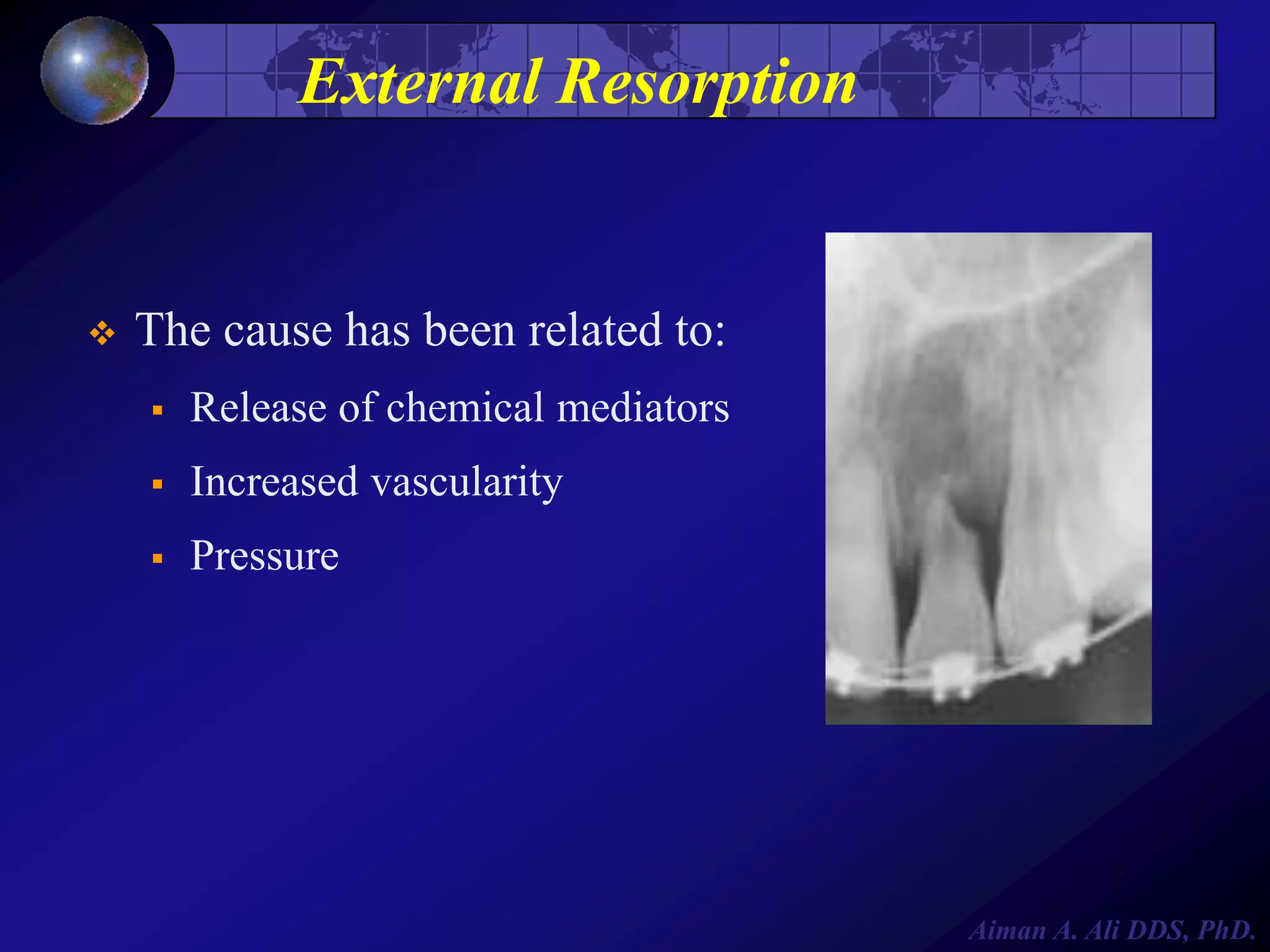 External Resorption



The cause has been related to:


Release of chemical mediators



Increased vascularity



Pressure

Aiman A. Ali DDS, PhD.

 