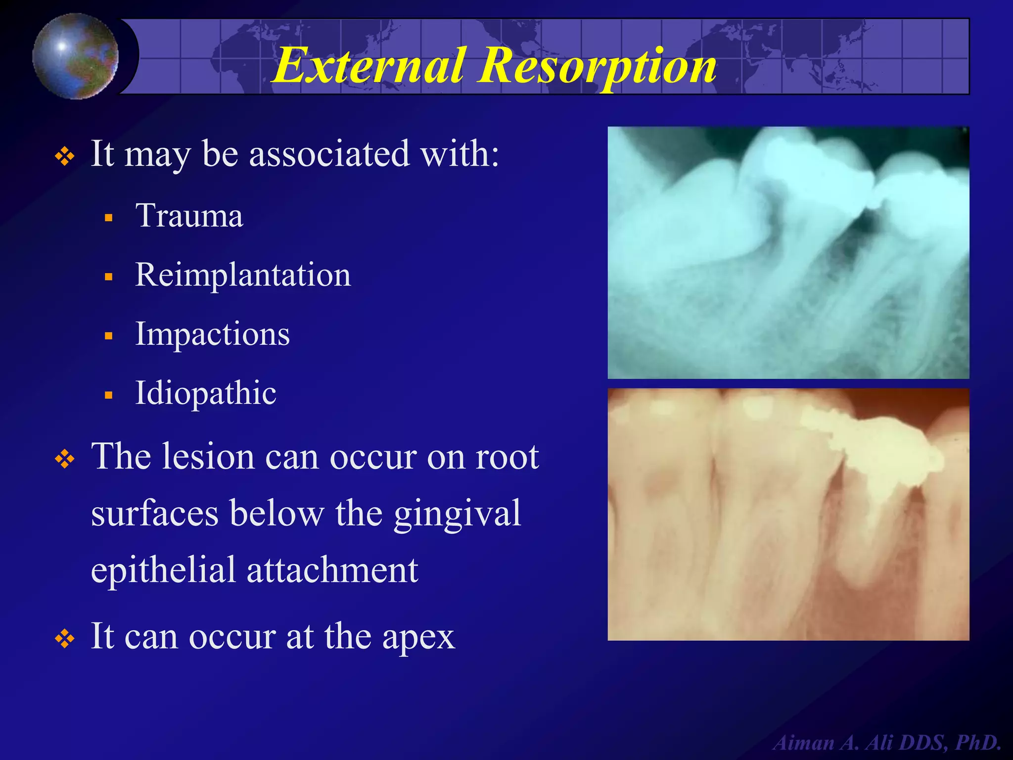 External Resorption


It may be associated with:


Trauma



Reimplantation



Impactions



Idiopathic



The lesion can occur on root
surfaces below the gingival
epithelial attachment



It can occur at the apex
Aiman A. Ali DDS, PhD.

 