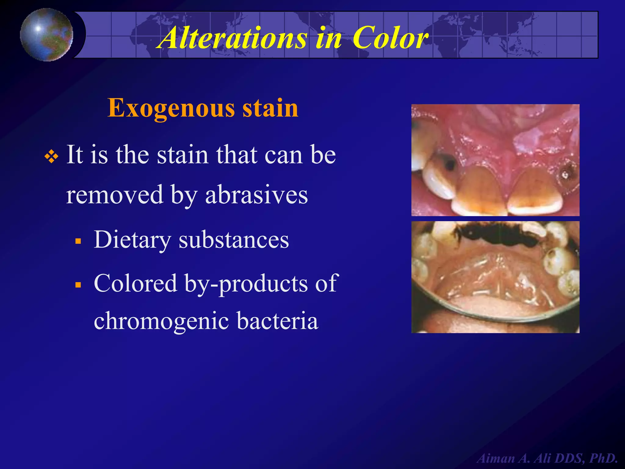 Alterations in Color
Exogenous stain


It is the stain that can be
removed by abrasives


Dietary substances



Colored by-products of
chromogenic bacteria

Aiman A. Ali DDS, PhD.

 