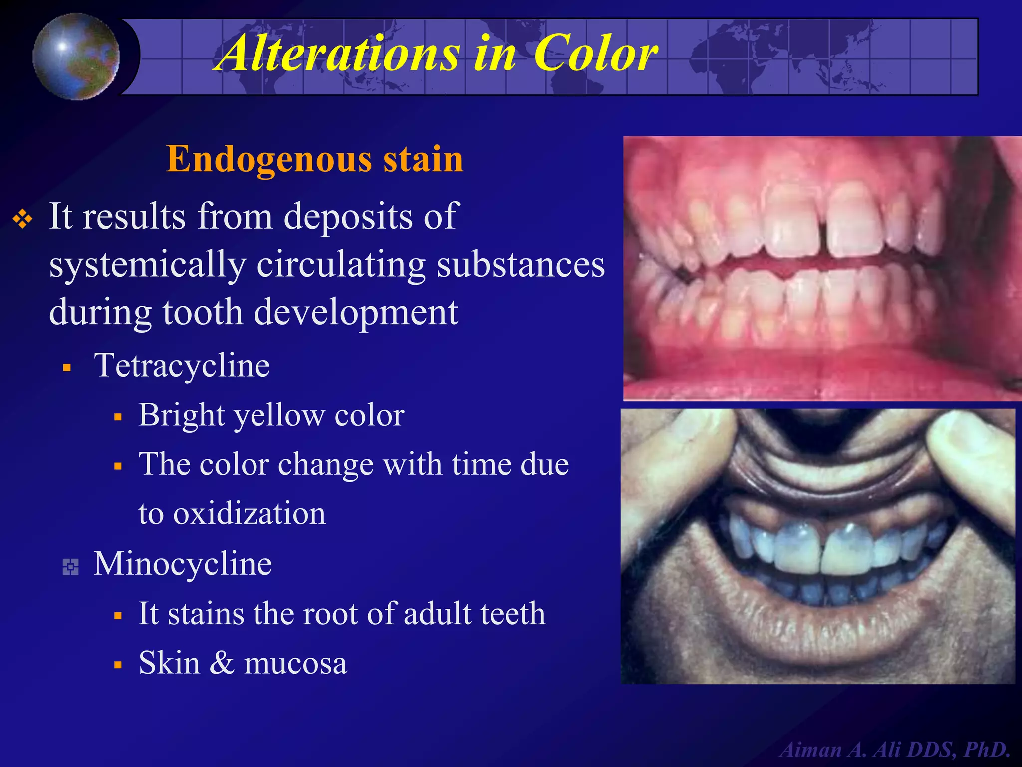 Alterations in Color


Endogenous stain
It results from deposits of
systemically circulating substances
during tooth development


Tetracycline
 Bright yellow color
 The color change with time due
to oxidization
Minocycline
 It stains the root of adult teeth
 Skin & mucosa
Aiman A. Ali DDS, PhD.

 