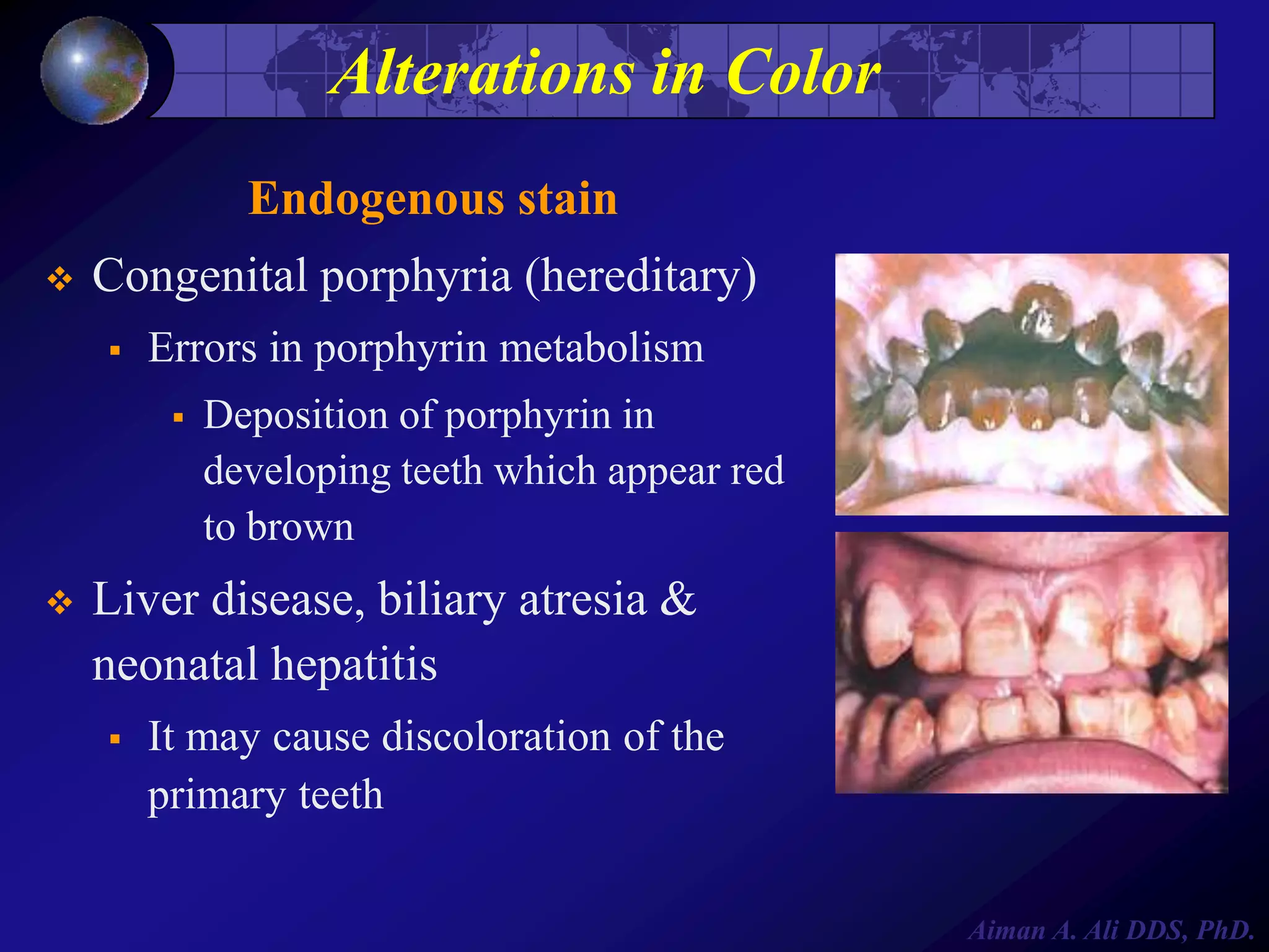 Alterations in Color
Endogenous stain


Congenital porphyria (hereditary)


Errors in porphyrin metabolism




Deposition of porphyrin in
developing teeth which appear red
to brown

Liver disease, biliary atresia &
neonatal hepatitis


It may cause discoloration of the
primary teeth
Aiman A. Ali DDS, PhD.

 