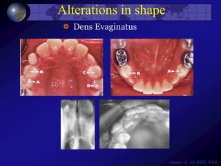 Opi 1-introduction-tooth abnormalities | PPTX