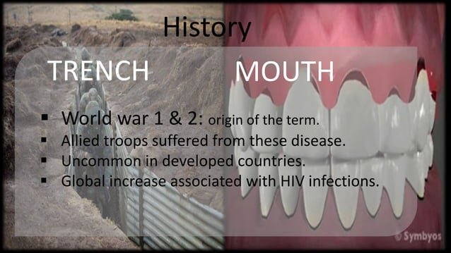 Trench mouth | PPTX