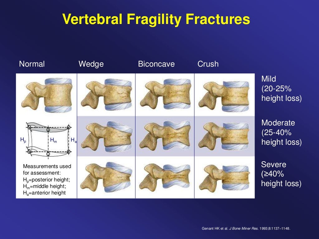 Vertebral Fracture Management, Professor Opinder Sahota flschampions