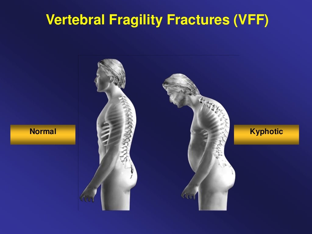 Vertebral Fracture Management, Professor Opinder Sahota flschampions