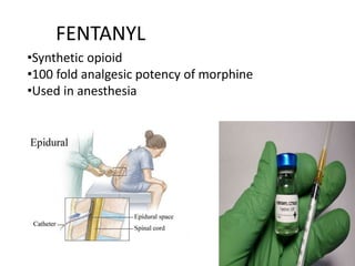 FENTANYL
•Synthetic opioid
•100 fold analgesic potency of morphine
•Used in anesthesia
 