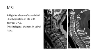 MRI
High incidence of associated
disc herniation in pts with
cervical OPLL.
Pathological changes in spinal
cord.
 