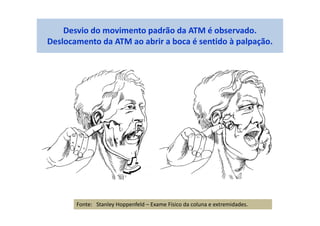 Desvio do movimento padrão da ATM é observado.
Deslocamento da ATM ao abrir a boca é sentido à palpação.
Fonte: Stanley Hoppenfeld – Exame Físico da coluna e extremidades.
 