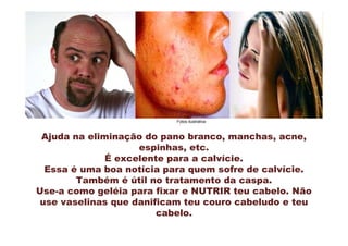 Fotos ilustrativa



 Ajuda na eliminação do pano branco, manchas, acne,
                    espinhas, etc.
              É excelente para a calvície.
  Essa é uma boa notícia para quem sofre de calvície.
        Também é útil no tratamento da caspa.
Use-a como geléia para fixar e NUTRIR teu cabelo. Não
 use vaselinas que danificam teu couro cabeludo e teu
                        cabelo.
 