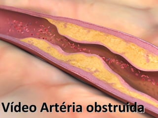 Vídeo Artéria obstruidaVídeo Artéria obstruida
 