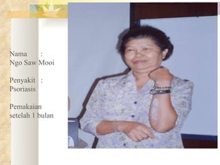 Nama   :  Ngo Saw Mooi Penyakit  : Psoriasis Pemakaian setelah 1 bulan 
