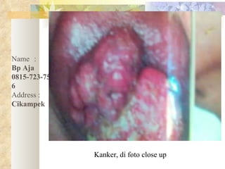 Kanker, di foto close up Name :   Bp Aja 0815-723-75006 Address :   Cikampek 