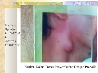 Kanker, Dalam Proses Penyembuhan Dengan Propolis Name :   Bp Aja 0815-723-75006 Address :   Cikampek 
