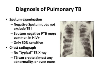 Diagnosis of Pulmonary TB
• Sputum examination
   – Negative Sputum does not
     exclude TB!
   – Sputum negative PTB more
     common in HIV+
   – Only 50% sensitive
• Chest radiograph
   – No “typical” TB X-ray
   – TB can create almost any
     abnormality, or even none
 