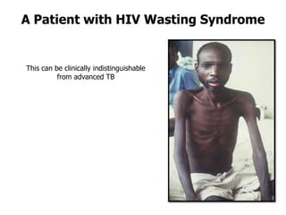 A Patient with HIV Wasting Syndrome


This can be clinically indistinguishable
          from advanced TB
 