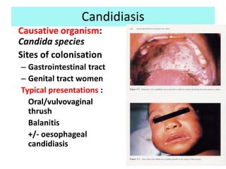 Candidiasis
Causative organism:
Candida species
Sites of colonisation
– Gastrointestinal tract
– Genital tract women
Typical presentations :
  Oral/vulvovaginal
  thrush
  Balanitis
  +/- oesophageal
  candidiasis
 
