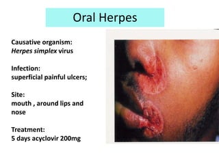 Oral Herpes
Causative organism:
Herpes simplex virus

Infection:
superficial painful ulcers;

Site:
mouth , around lips and
nose

Treatment:
5 days acyclovir 200mg
 