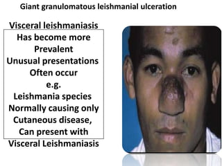 Giant granulomatous leishmanial ulceration

Visceral leishmaniasis
  Has become more
      Prevalent
Unusual presentations
     Often occur
          e.g.
 Leishmania species
Normally causing only
 Cutaneous disease,
   Can present with
Visceral Leishmaniasis
 