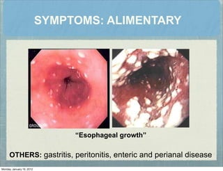 “Esophageal growth”
OTHERS: gastritis, peritonitis, enteric and perianal disease
SYMPTOMS: ALIMENTARY
Monday, January 16, 2012
 