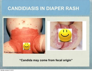 CANDIDIASIS IN DIAPER RASH
“Candida may come from fecal origin”
Monday, January 16, 2012
 