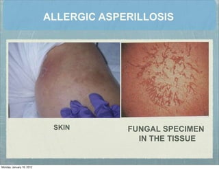 ALLERGIC ASPERILLOSIS
SKIN FUNGAL SPECIMEN
IN THE TISSUE
Monday, January 16, 2012
 