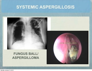 SYSTEMIC ASPERGILLOSIS
FUNGUS BALL/
ASPERGILLOMA
Monday, January 16, 2012
 