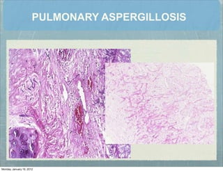 PULMONARY ASPERGILLOSIS
Monday, January 16, 2012
 