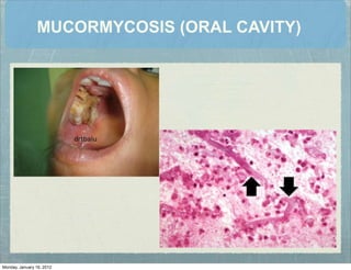 MUCORMYCOSIS (ORAL CAVITY)
Monday, January 16, 2012
 