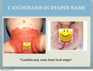 CANDIDIASIS IN DIAPER RASH




                           “Candida may come from fecal origin”


Monday, January 16, 2012
 