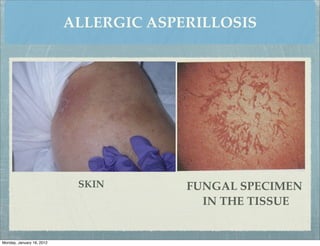 ALLERGIC ASPERILLOSIS




                            SKIN        FUNGAL SPECIMEN
                                          IN THE TISSUE


Monday, January 16, 2012
 