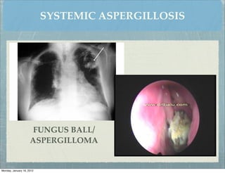 SYSTEMIC ASPERGILLOSIS




                      FUNGUS BALL/
                     ASPERGILLOMA


Monday, January 16, 2012
 