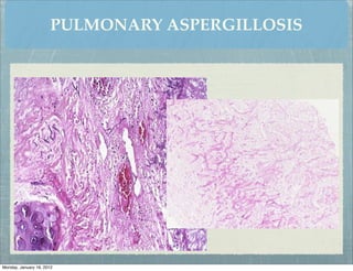 PULMONARY ASPERGILLOSIS




Monday, January 16, 2012
 