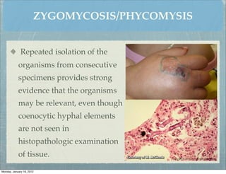 ZYGOMYCOSIS/PHYCOMYSIS


              Repeated isolation of the
            organisms from consecutive
            specimens provides strong
            evidence that the organisms
            may be relevant, even though
            coenocytic hyphal elements
            are not seen in
            histopathologic examination
            of tissue.

Monday, January 16, 2012
 