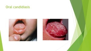 Oral candidiasis
 