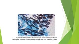 Aspergillus in tissue showing acute angle branching, septate hyphae
 