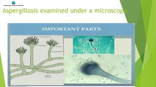 Aspergillosis examined under a microscope
 