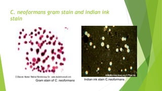 C. neoformans gram stain and indian ink
stain
Gram stain of C. neoformans Indian ink stain C.neoformans
 